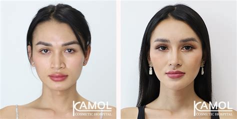 Facial Feminization Surgery in Thailand .